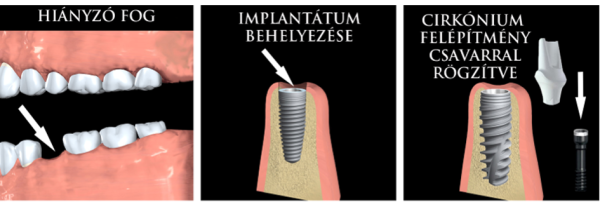 gbdental - implantáció  1