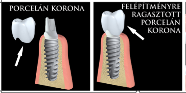 gbdental - implantáció  2