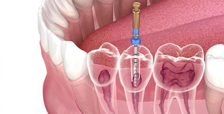 foggyökér csatorna tisztítása